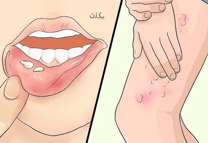 Genital Herpes Cure – What Are the Options For a Genital Herpes Cure?